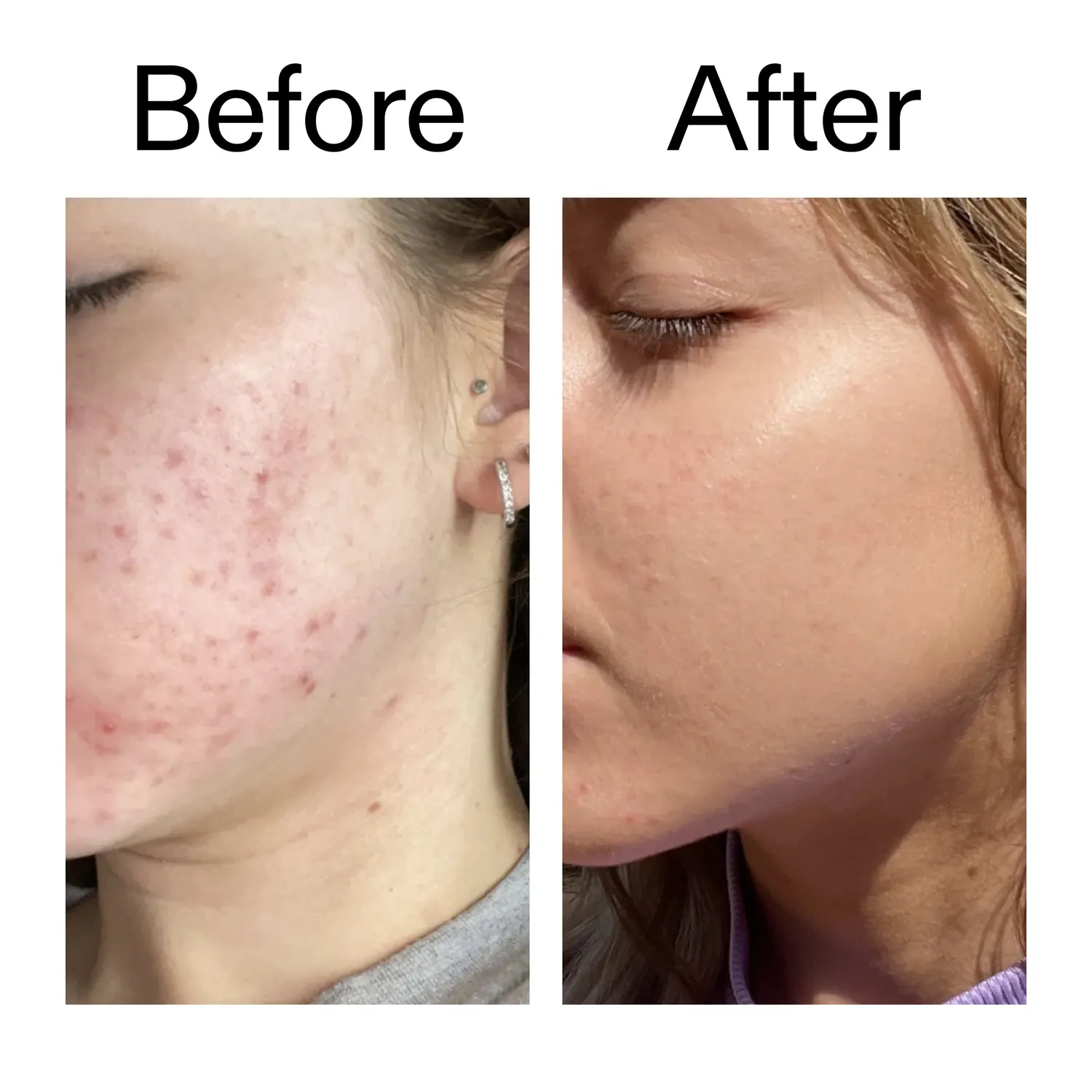 THE INKEY LIST 10% Niacinamide Sérum 30ml peau grasse